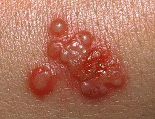 images of vaginal herpes #10