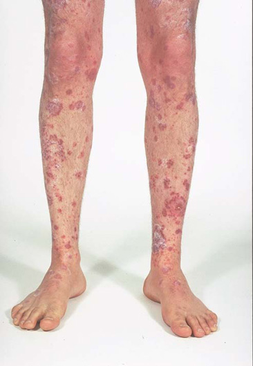 How To Get Rid Of Heat Rash Between The Legs Fast