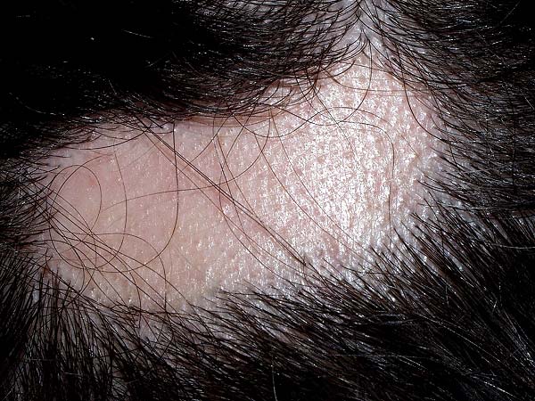 Alopecia infecciosa