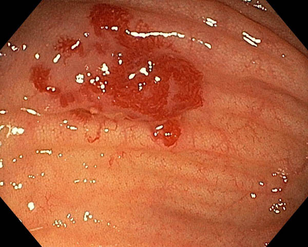 Angiodisplasia del colon