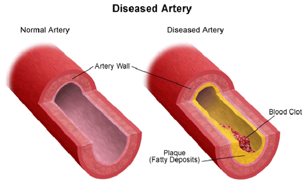 Arteriosclerosis 