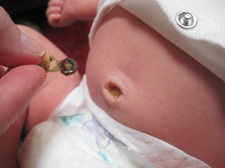 Cordón umbilical del bebé