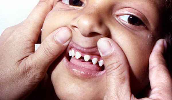 Desarrollo anormal de los dientes