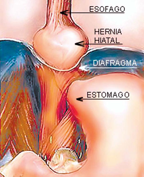 Hernia hiatal