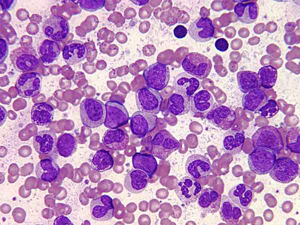 Leucemia mielógena crónica