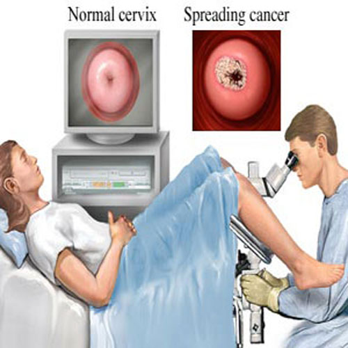 Mitos del cancer cervical