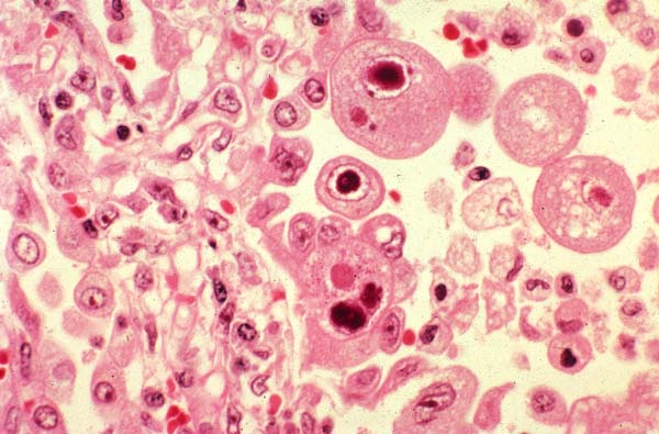 Neumonía por citomegalovirus