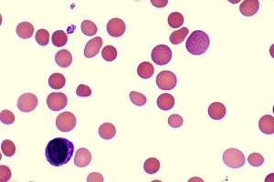 Anemia hemolítica