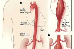 Aneurisma aortico abdominal