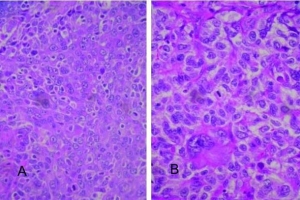 Carcinoma hepatocelular