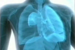 Colapso pulmonar