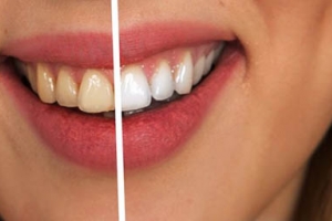 Eliminar el sarro de los dientes con remedios naturales