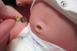 Cordón umbilical del bebé
