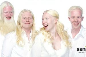 albinismo