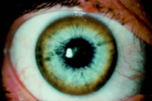 Color amarillo en la esclerótica del ojo