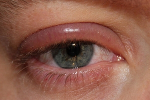 Síndrome oculoglandular de Blefaritis