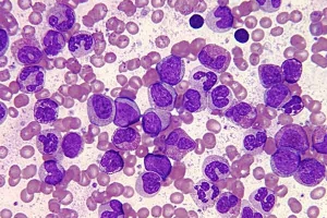 Leucemia mielógena crónica