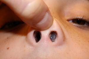 Pólipos nasales