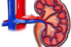 Estenosis de la arteria renal 