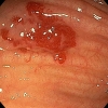 Angiodisplasia del colon