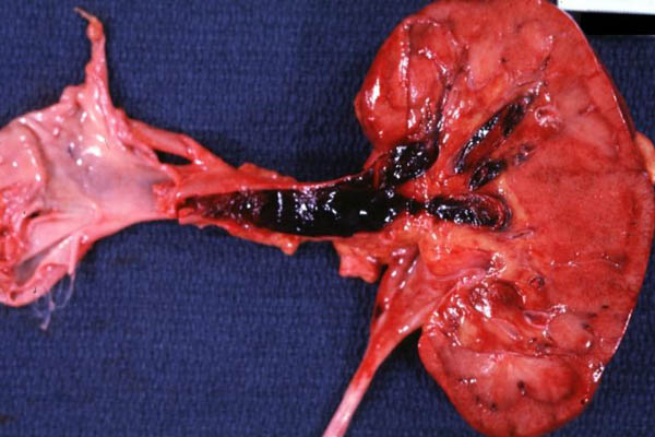 Trombosis de la vena renal y Obstrucción de la vena cava superior