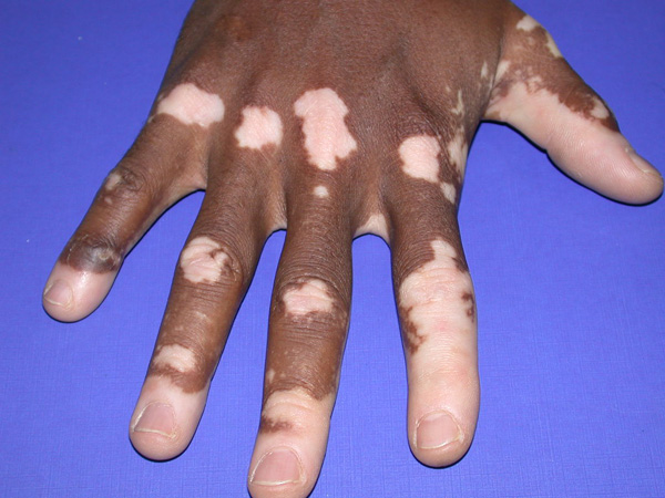 Causas y tratamiento del Vitiligo